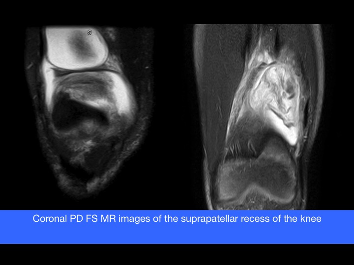Figure 2 for case Symptomatic complete type of suprapatellar plica of the knee